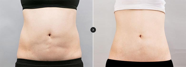 커스터마이징 솔루션