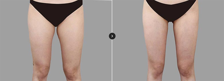 커스터마이징 솔루션