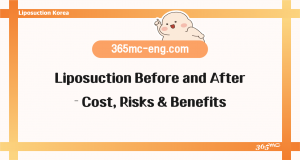 Liposuction Before and After – Cost, Risks & Benefits