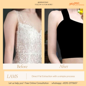 img 1 LAMS IS MAGIC Before and after comparison of LAMS Direct Fat Extraction on a woman's arm.