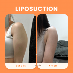 [IMAGE 1 LIPO]