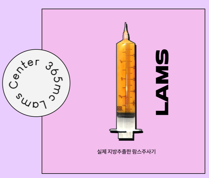 A syringe filled with extracted fat from the LAMS procedure at 365mc.